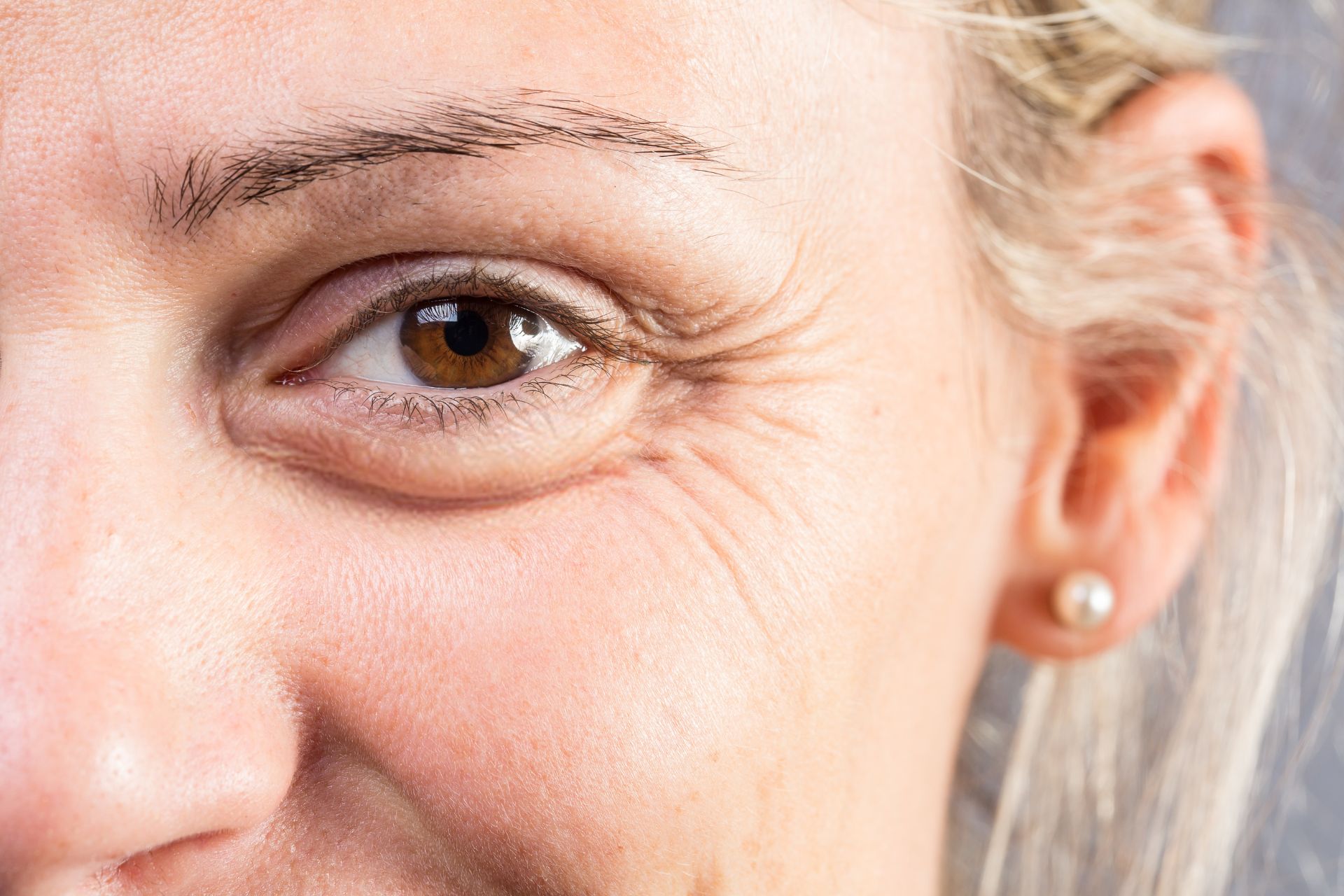Krähenfüße mit Botox behandeln