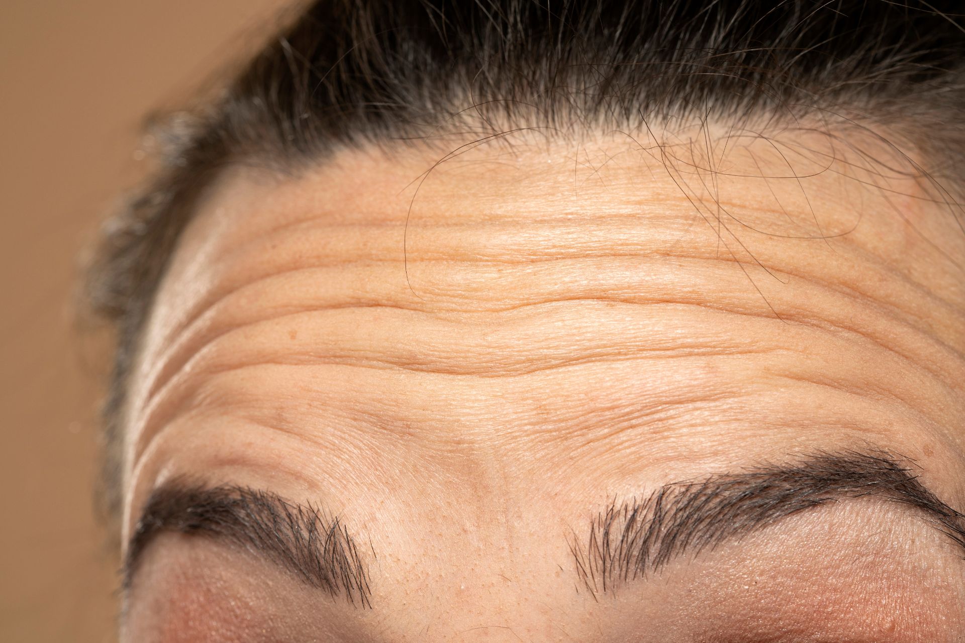Stirnfalten glätten mit Botox (Botulinumtoxin)